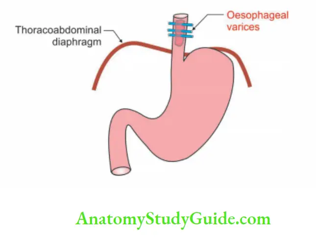 Abdominal Part of Oesophagus and Stomach Oesophageal varices