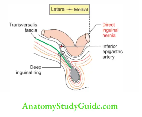 Anterior Abdominal Wall Direct inguinal hernia on right side