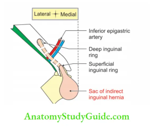 Anterior Abdominal Wall Indirect inguinal hernia on right side