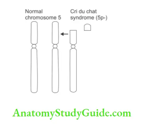 Chromosomes and their Aberrations Cri du chat syndrome