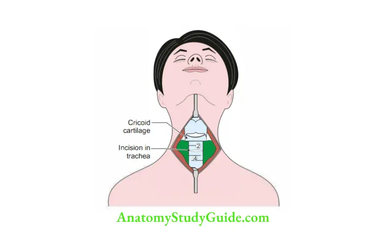 Deep Structure in the Neck Incision of isthmus during tracheostomy