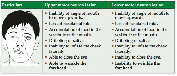 Differences between upper motor neuron and lower motor neuron lesions (Contd.)