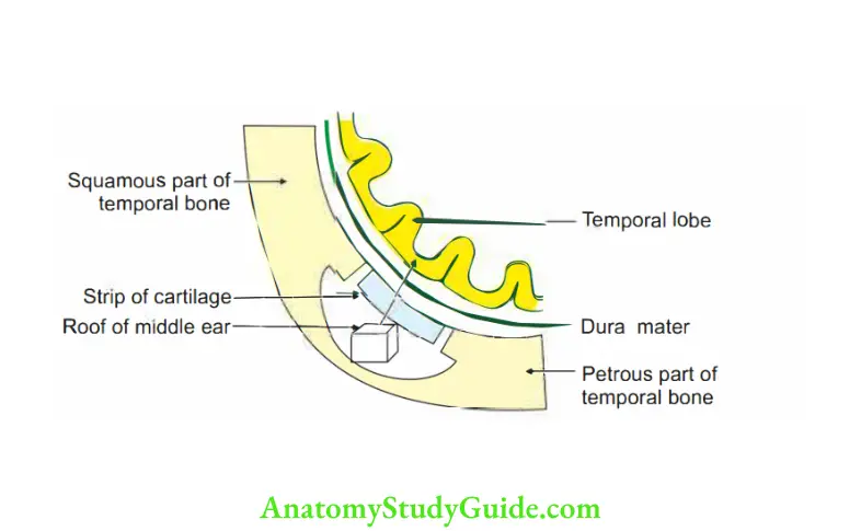 Ear Spread of infection from roof of middle ear to temporal lobe of cerebral cortex