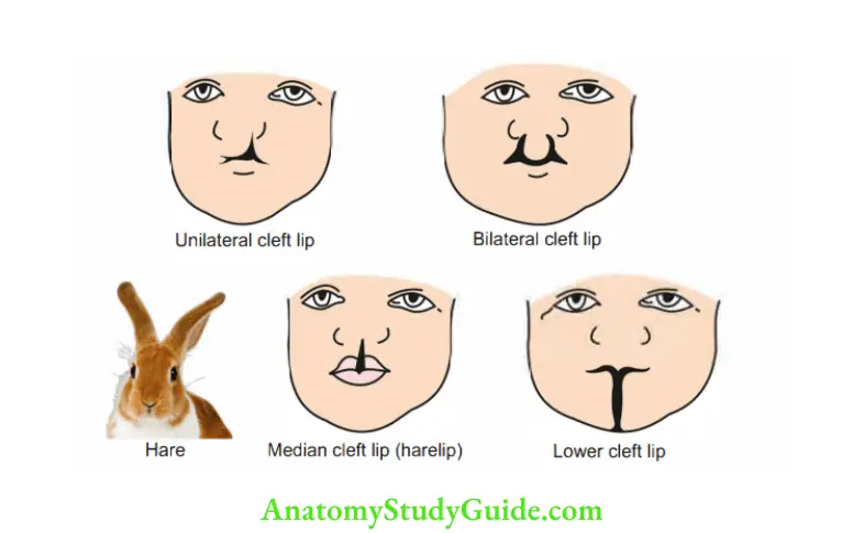 Head, Neck Face Embryology Developmental anomalies of face