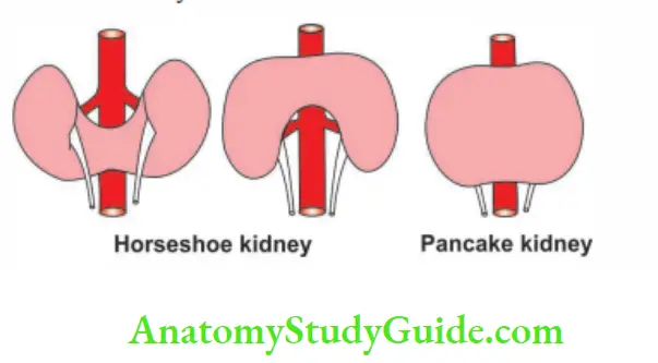 Kidney And Ureter Anomalies of the Kidney