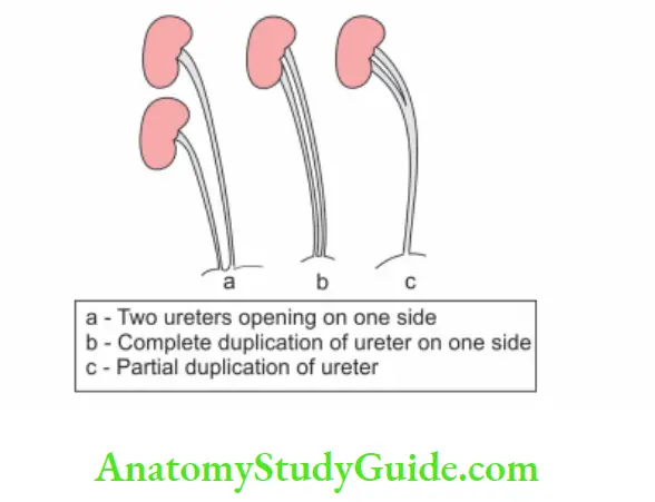 Kidney And Ureter Anomalies of ureter