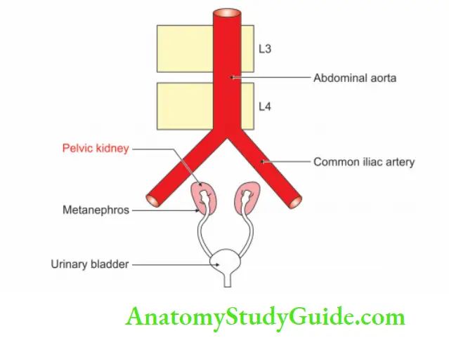 Kidney And Ureter Pelvic Kidney