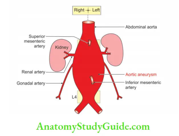 Large Blood Vessels of the Gut Aortic aneurysm