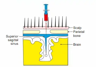 Puncture of superior sagittal sinus to get venous blood