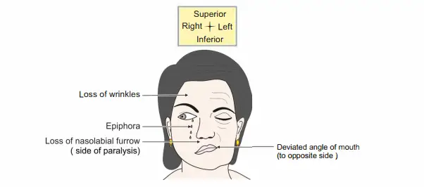 Right Bell's palsy