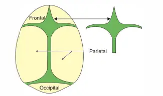 Shape of anterior fontanelle