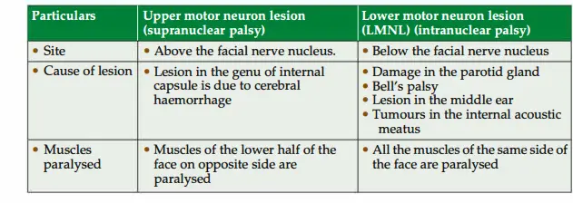 Upper and lower motor neuron lesions of facial nerve