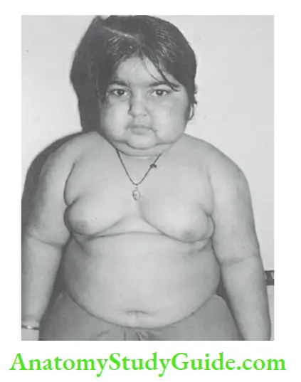 Anthropometry for Assessment of nutritional status A 3-year-old girl with obesity due to Cushing’s syndrome as a result of carcinoma of adrenal cortex.