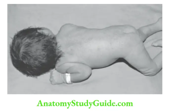 Developmental assessment Prone position. Head is moved to one side and pelvis is raised in a newborn baby.