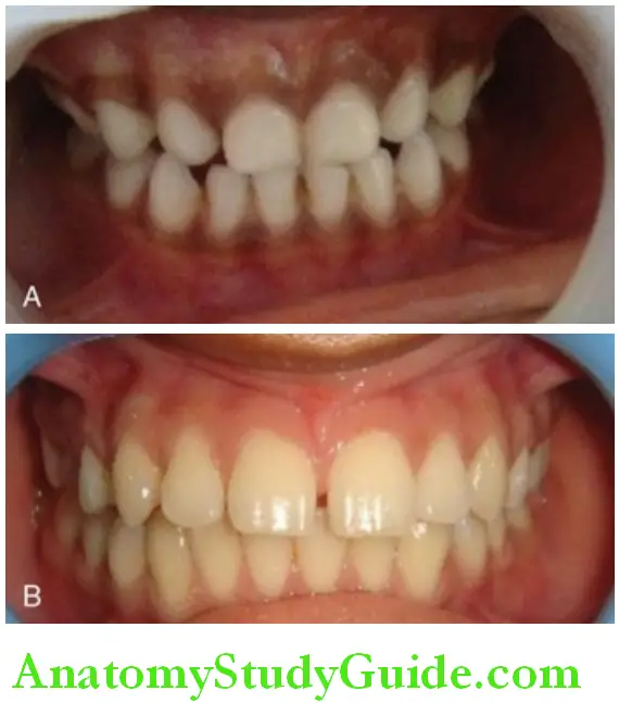 Differences Between Primary And Permanent Dentition colour of primary teeth and colour of permanent teeth