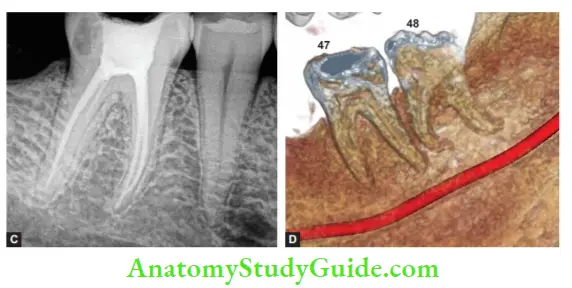 Endodontics Introduction Notes 2D radiographic image of teeth and (D) 3D image of teeth and surrounding tissues in CBCT.