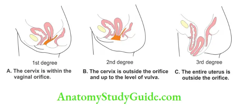 Female Reproductive Organs Degree of prolapse of uterus