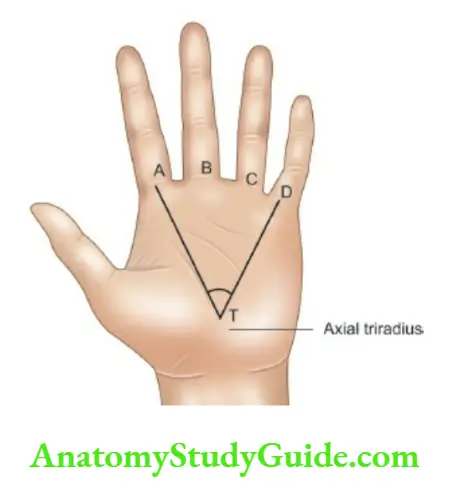 General physical Single palmar crease and ATD angle by joining AD distal triradii with axial triradius (T).