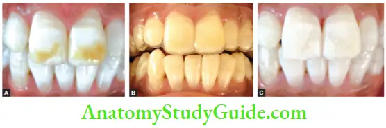 Management Of Discolored Teeth Bleaching awith Night Guard