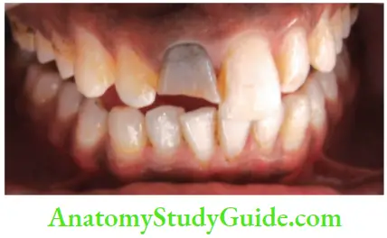 Management Of Discolored Teeth Discoloration Of Right Maxillary Central Incisor Due To Pulp Necrosis