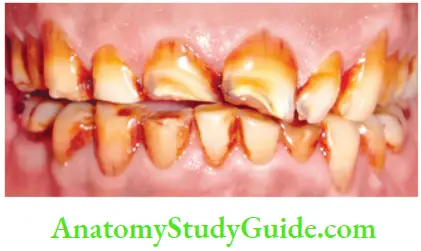 Management Of Discolored Teeth Discoloration Of Teeth Resulting From tooth Wear And Aging