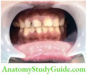 Management Of Discolored Teeth Discolored Appearance Of Teeth Due To Caries