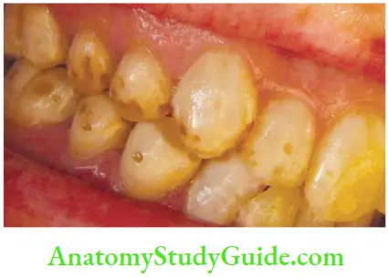 Management Of Discolored Teeth Fluorosis Of Teeth Showing Pitting And Brownish Discoloration