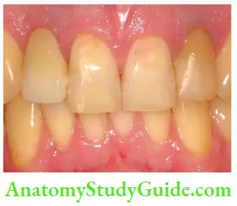 Management Of Discolored Teeth Fluorosis Of Teeth Showing YellowTo Brown Discoloration Of Teeth