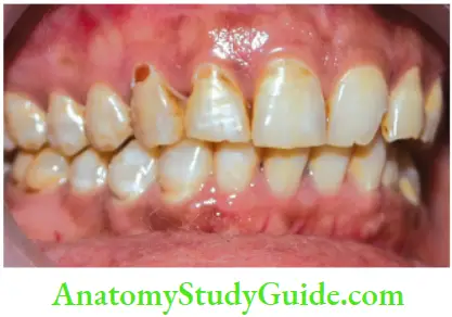 Management Of Discolored Teeth Fluorosis Of teeth In Form Of Hypomineralized Brownish Discoloration