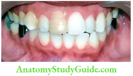 Management Of Discolored Teeth Loss Of Translucency Of Right Maxillary Central Incisor Due To Pulp Necrosis