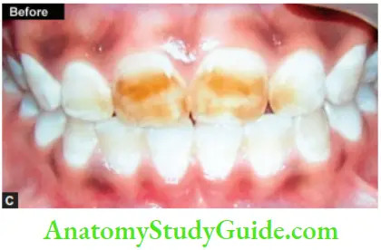 Management Of Discolored Teeth Maxillary Central Incisors Showing Discoloration