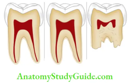 Management Of Discolored Teeth Normal Tooth, Dentinogenesis Imperfecta, Dentin Dysplasis