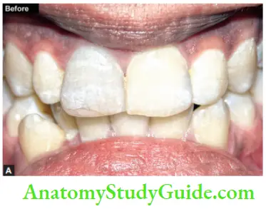 Management Of Discolored Teeth Preoperative Ohotograph Showing Discolord