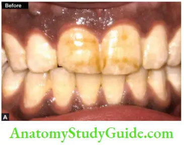 Management Of Discolored Teeth Preoperative Photograph Showing Discolored