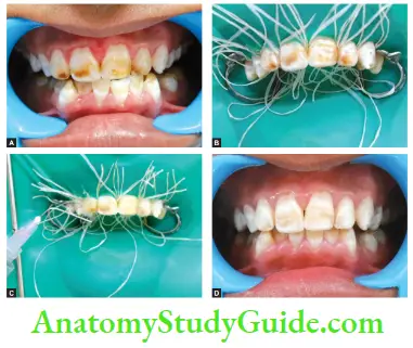 Management Of Discolored Teeth Steps Of In Office Bleaching