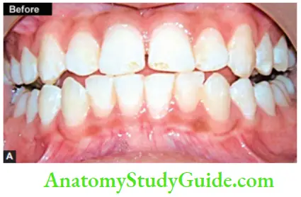 Management Of Discolored Teeth Superficial Stains On Maxillary Anteriors