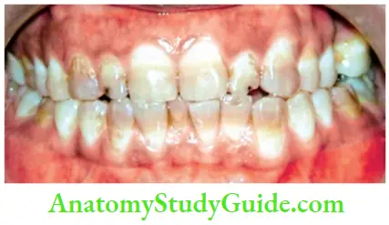 Management Of Discolored Teeth Tetracycline Stains