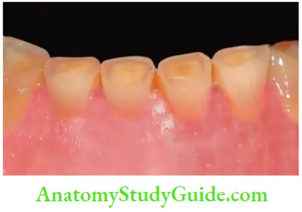 Management Of Discolored Teeth Yellowish Discoloration Of Teeth Due To Secondary And Tertiary Deposistion