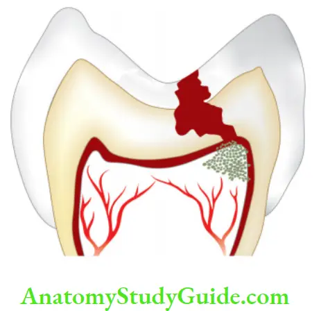 Pathologies Of Pulp And Periapex Notes Deep dental caries causing exposure of pulp.
