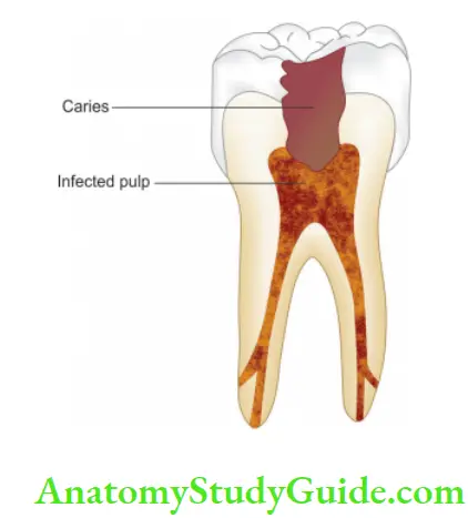 Pathologies Of Pulp And Periapex Notes Dental caries results in pulpal inflmmation.