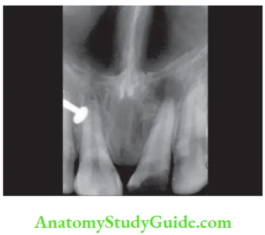 Pathologies Of Pulp And Periapex Notes Diagnosis Pulp necrosis; symptomatic apical periodontitis