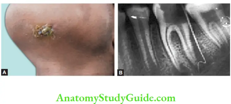 Pathologies Of Pulp And Periapex Notes Extraoral sinus, Source of sinus tracked using gutta-percha