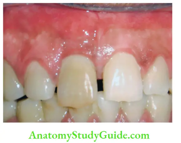 Pathologies Of Pulp And Periapex Notes Lack of normal translucency in nonvital maxillary right central incisor.