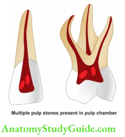 Pathologies Of Pulp And Periapex Notes Line diagram showing pulp stones present in pulp chamber of teeth