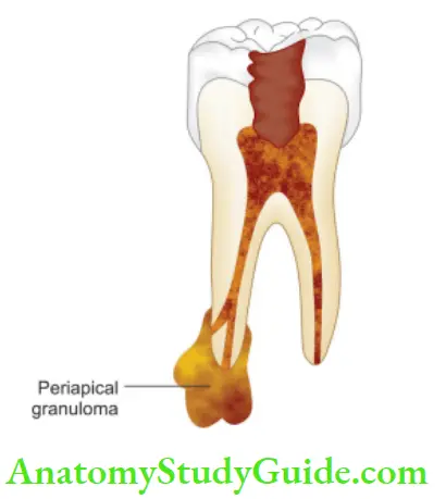 Pathologies Of Pulp And Periapex Notes Periapical granuloma present at the apex of nonvital tooth.