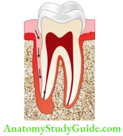 Pathologies Of Pulp And Periapex Notes Periodontal pocket