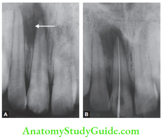 Pathologies Of Pulp And Periapex Notes Preoperative radiograph showing external resorption; Working length radiograph