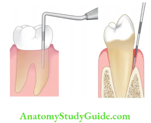 Pathologies Of Pulp And Periapex Notes Probing of tooth determines the level of connective tissue attachment.
