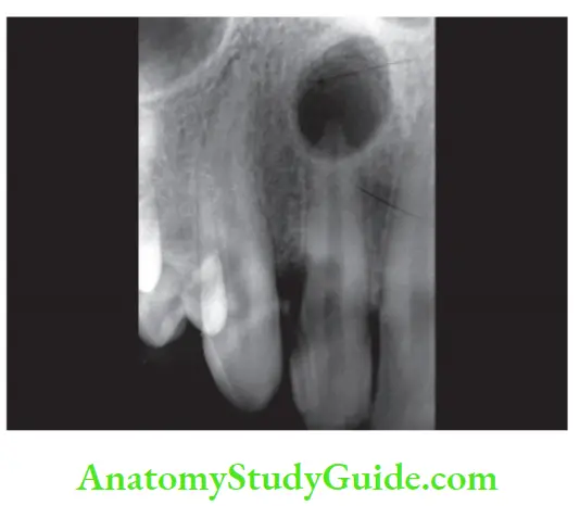 Pathologies Of Pulp And Periapex Notes Radicular cyst in relation to maxillary lateral incisor