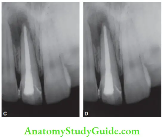 Pathologies Of Pulp And Periapex Notes Radiograph after obturation; Follow-up after 6 months.
